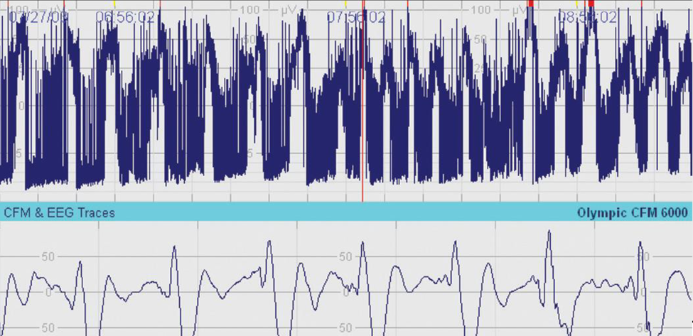 Understanding Amplitude-Integrated Electroencephalography in